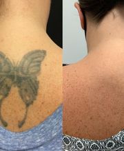 Removery Tattoo Removal & Fading image 6