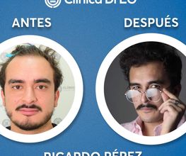 Clinica DrEO - Injerto de Cabello y Barba imagen 8
