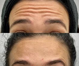 Juvenalia Brío | Botox, Hydrafacial & Ultraformer - Condesa / Roma Norte CDMX imagen 12