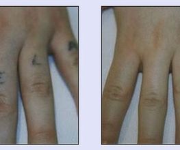 Tattooentfernung VN 4.jpg