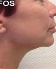 Dr Eric BONAFOS Chirurgien Esthétique Montpellier Chirurgie de la face et du cou image 10