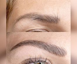 Brow Lifting