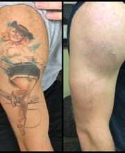 Removery Tattoo Removal & Fading image 8