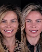Lente de Contato Dental, Dr. Marcelo Borille imagen 12