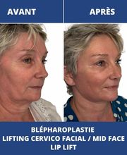 Dr Philippe Legaillard | Chirurgien esthétique Bordeaux | Lifting | Paupières | Rhinoplastie | Augmentation mammaire | Botox image 6