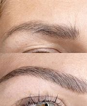 Brow Lifting