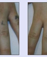 Tattooentfernung VN 4.jpg