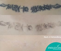 ENDLICH OHNE Tattooentfernung Berlin Bild 19
