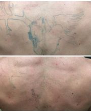 Removery Tattoo Removal & Fading image 4