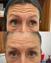 Juvenalia Brío | Botox, Hydrafacial & Ultraformer - Condesa / Roma Norte CDMX imagen 9