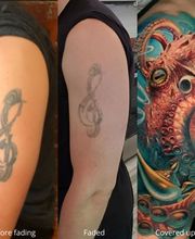 Removery Tattoo Removal & Fading image 7