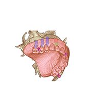 CODIAGNOSTIX™ – DIE DENTAL WINGS SOFTWARE FÜR DIE VIRTUELLE 3D-IMPLANTAT-NAVIGATION