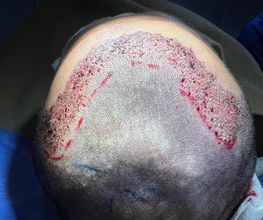 Clinica DrEO - Injerto de Cabello y Barba imagen 19