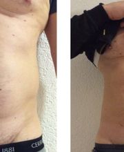 Medical Aesthetic Fettabsaugen Dr. Urs Benz Bild 3