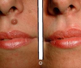 Ablation grain beauté au laser