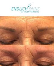ENDLICH OHNE Tattooentfernung Filiale Leipzig Bild 11