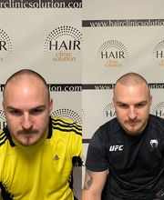 Hair clinic solution spécialiste en micropigmentation du cheveux à Marseille image 2