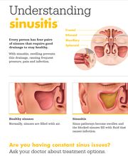 Understanding sinusitis
