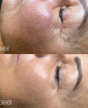 Sara_Pavo_Cosmetics_kristallmicrodermabrasion_essen.jpg