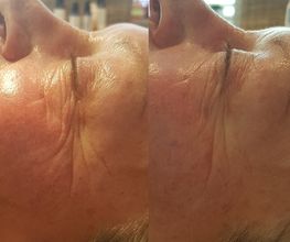 Resultaat na 1x HydroPeptide behandeling