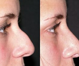 Rhinoplastie médicale