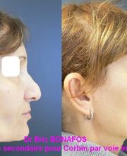 Dr Eric BONAFOS Chirurgien Esthétique Montpellier Chirurgie de la face et du cou image 13