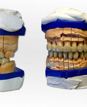 manchegos-protesis-dental-maquetas-rehabilitacion-02.jpg