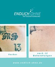 ENDLICH OHNE Tattooentfernung Filiale Bremen Bild 9