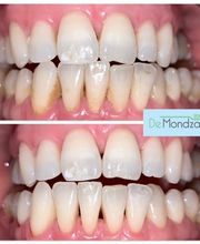 Deze mooie resultaten zijn behaald door de EMS Airflow en hand reiniging.