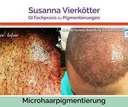 MicrohaarPigmentierung Korrektur