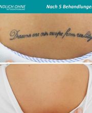 ENDLICH OHNE Tattooentfernung Filiale Dresden/Pirna Bild 12