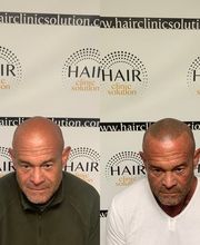 Hair clinic solution spécialiste en micropigmentation du cheveux à Marseille image 8