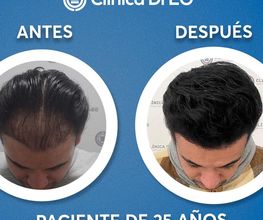 Clinica DrEO - Injerto de Cabello y Barba imagen 7