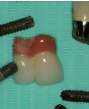 clinica-dental-dr-cuesta-implantes-03.jpg