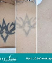 ENDLICH OHNE Tattooentfernung Filiale Heilbronn Bild 8