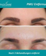 ENDLICH OHNE Tattooentfernung Filiale Leipzig Bild 8