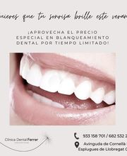 blanqueamiento-dental-cornella.jpg.jpeg
