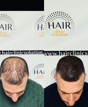 Hair clinic solution spécialiste en micropigmentation du cheveux à Marseille image 14