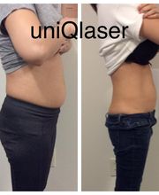 UniQ Laser Center Watertown image 20