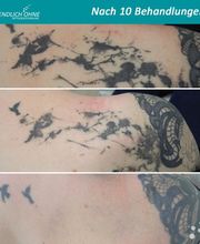 ENDLICH OHNE Tattooentfernung Berlin Bild 3