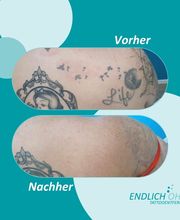 ENDLICH OHNE Tattooentfernung Filiale Kassel Bild 18