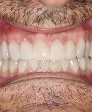 clinica-dental-jose-castro-herrero-dientes-blancos-03.jpg