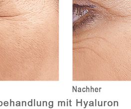 Kraehenfueßebehandlung mit Hyaloron
