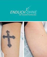 ENDLICH OHNE Tattooentfernung Berlin Bild 6