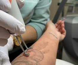 ENDLICH OHNE Tattooentfernung Filiale Bielefeld Bild 8