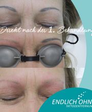 ENDLICH OHNE Tattooentfernung Filiale Leipzig Bild 9