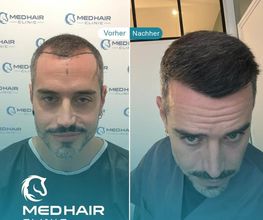 MedHair Clinic | Haartransplantationen in der Türkei Istanbul Bild 11