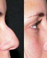 Rhinoplastie médicale