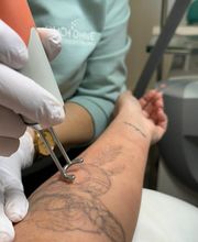 ENDLICH OHNE Tattooentfernung Filiale Bremen Bild 1
