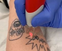 ENDLICH OHNE Tattooentfernung Berlin Bild 2